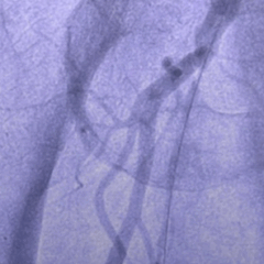 Jetstream : Innovation en Recanalisation Fémorale